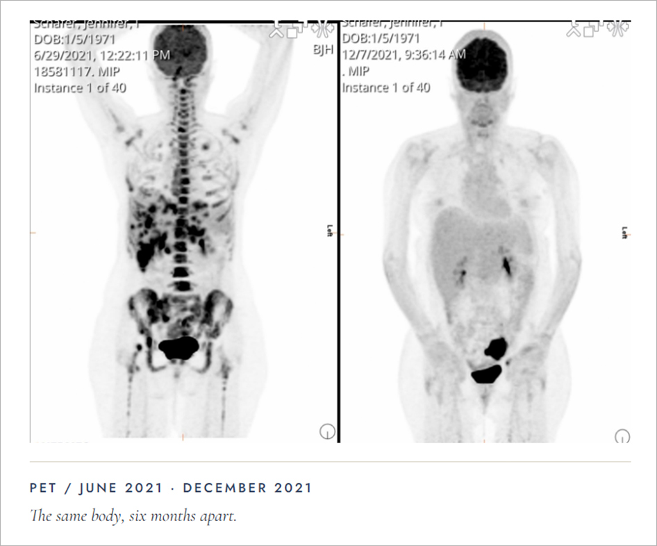 PET-scan