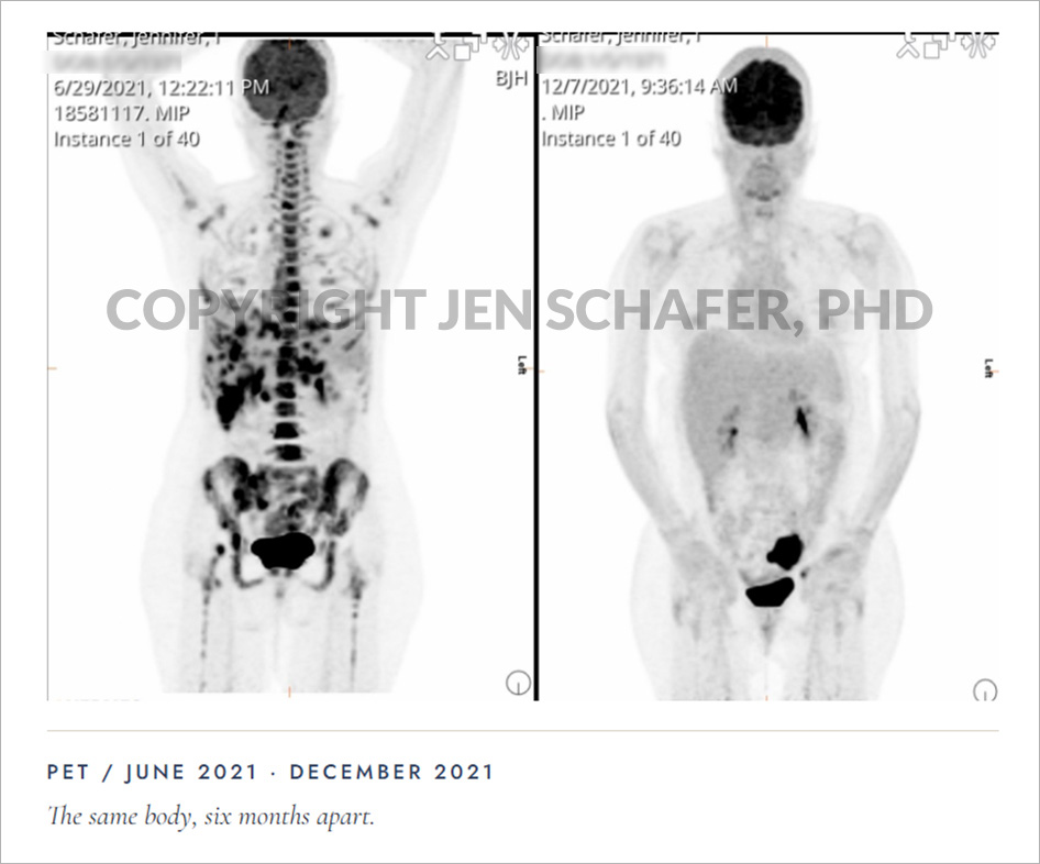 Jen Schafer PET scan comparison Jen Schafer PET Scan, watermarked, showing before and after.
